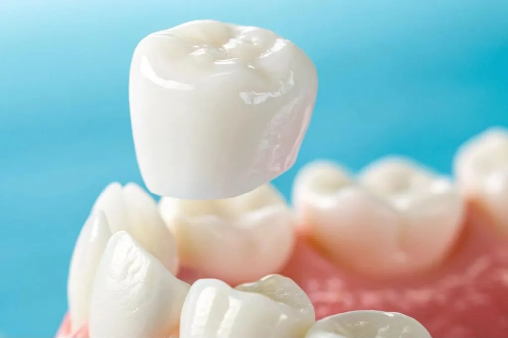 Detailed 3D model of a human tooth with a ceramic dental crown being positioned over the prepared natural tooth structure representing the final stage of restorative treatment for damaged or decayed teeth