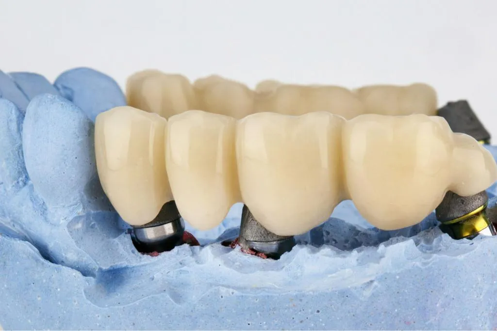 Close-up of a blue dental mold featuring multiple ceramic crowns fitted to replicate natural teeth color and contour highlighting precision craftsmanship and aesthetic restorative dentistry