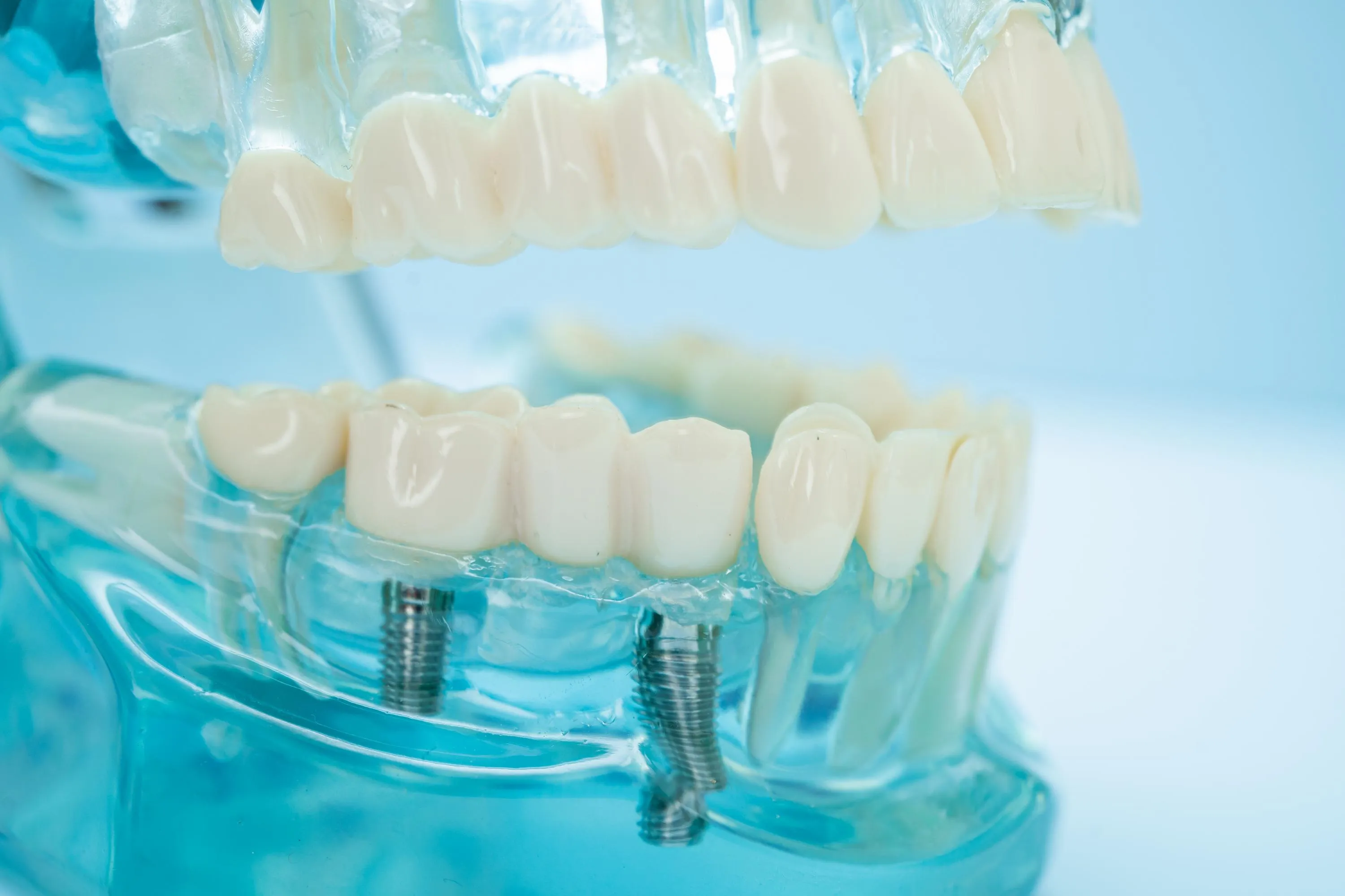 Transparent dental model showing a full bridge with dental implants used to demonstrate tooth replacement options and restorative dentistry procedures