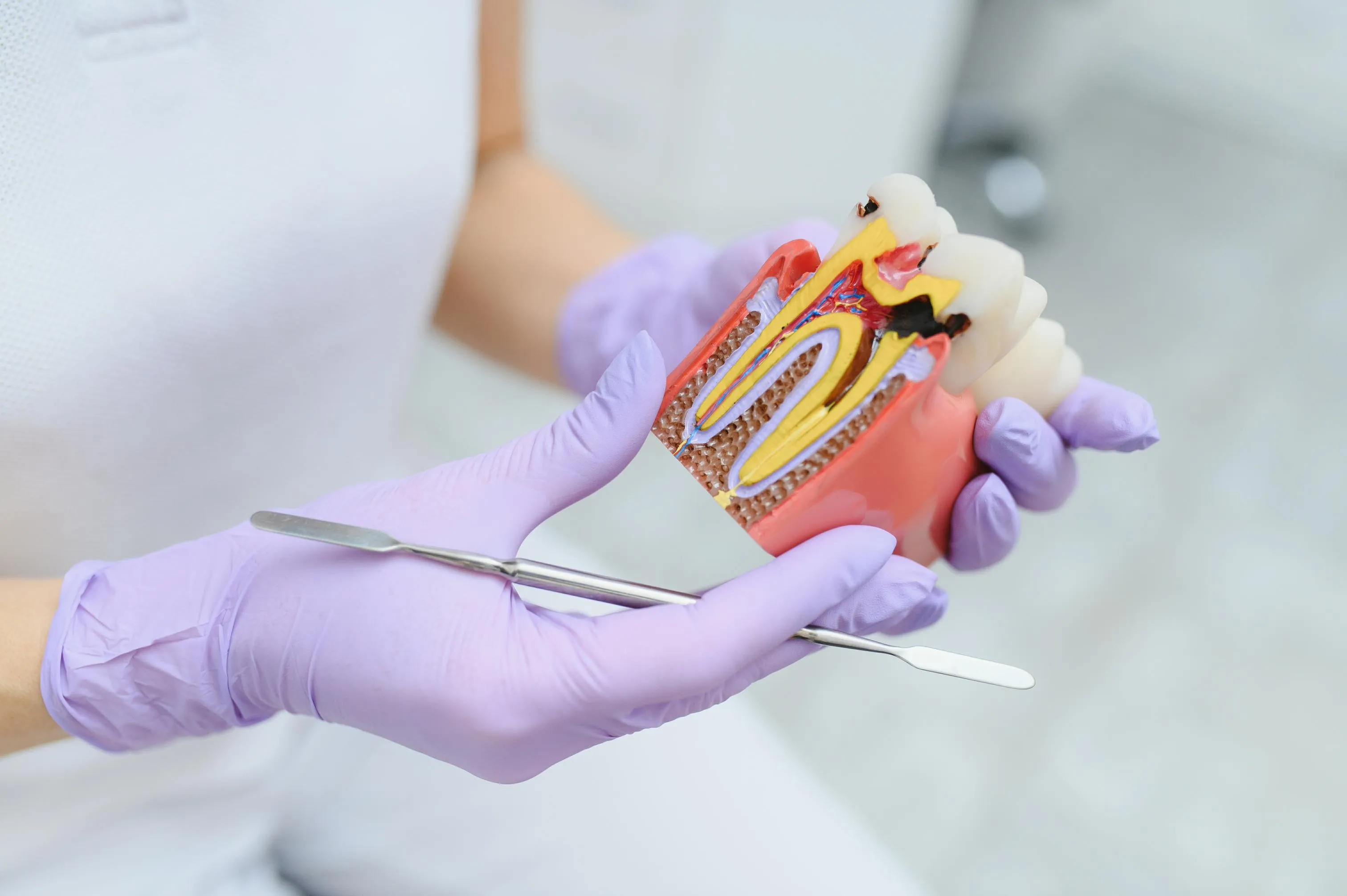Dentist wearing purple gloves holding an educational model of a tooth showing root canal structure and infection treatment process in a dental clinic