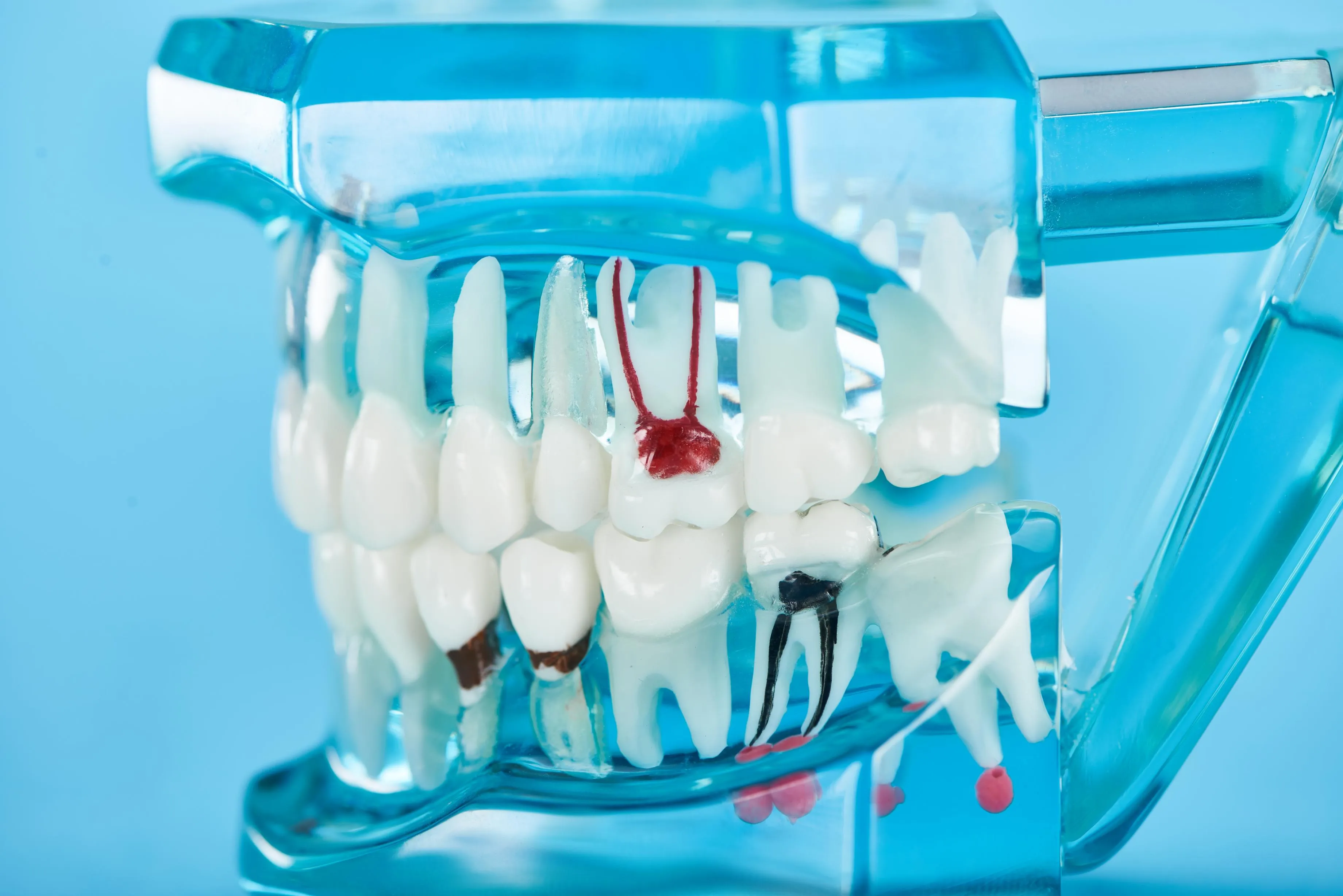 Transparent anatomical dental model displaying teeth, roots, and gums used for patient education about oral anatomy and restorative dental procedures