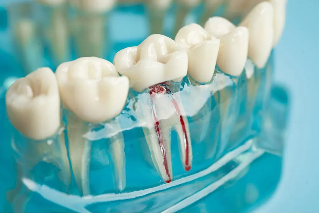 Close-up of a dental model with artificial teeth and implants demonstrating how dental bridges replace missing teeth and restore proper bite alignment