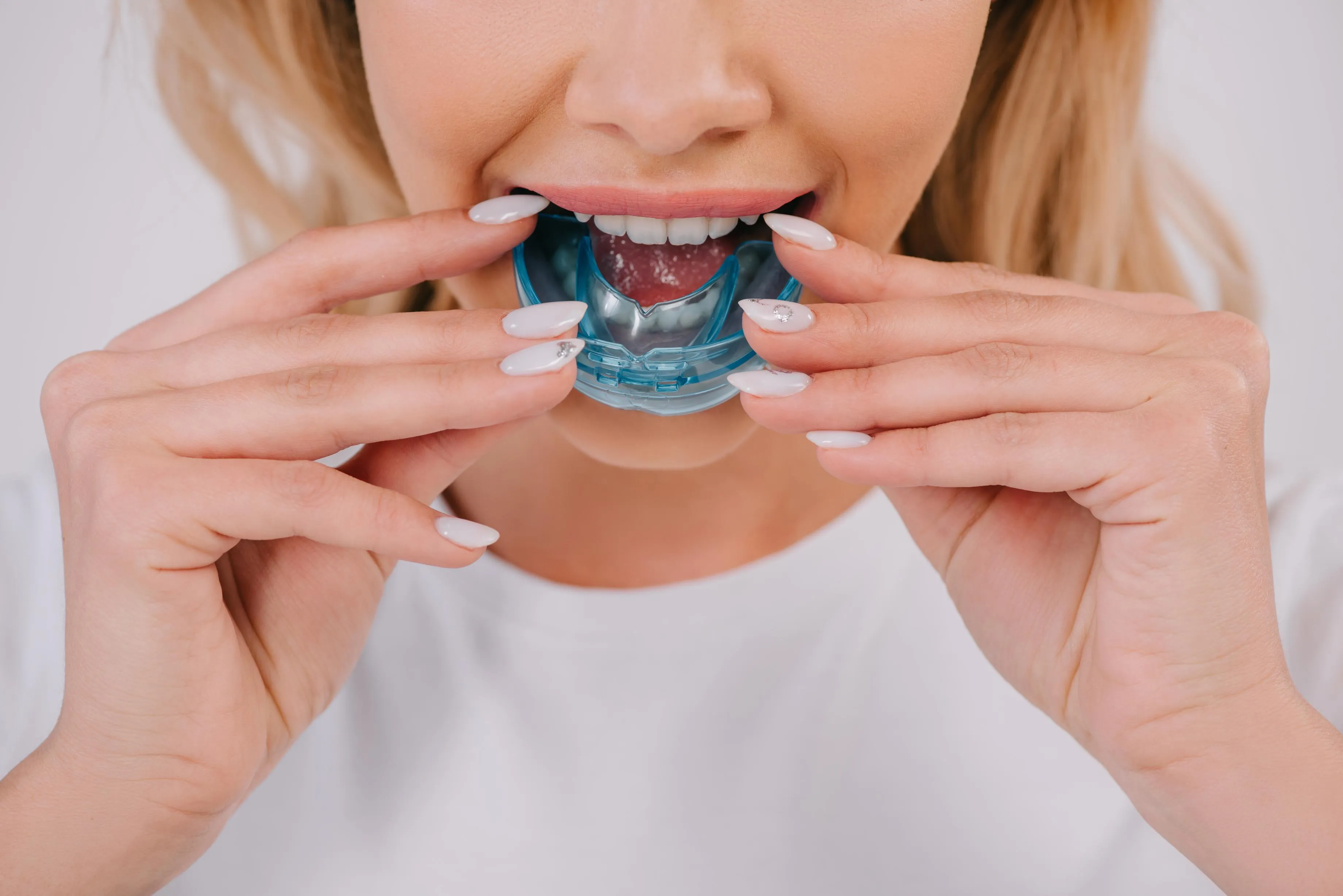 Close-up of a woman fitting a protective mouthguard onto her teeth demonstrating proper use of custom dental guards for sports safety and nighttime teeth grinding prevention