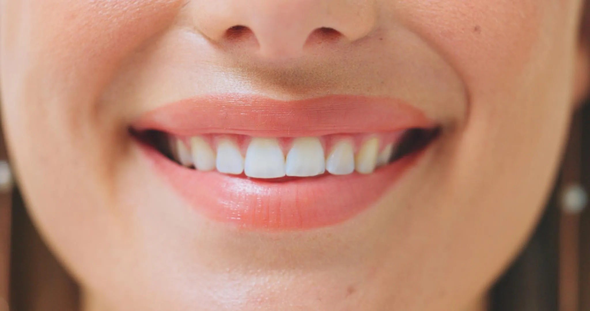 Close-up of a woman’s mouth showing a bright white smile after professional teeth whitening treatment symbolizing effective cosmetic dentistry results