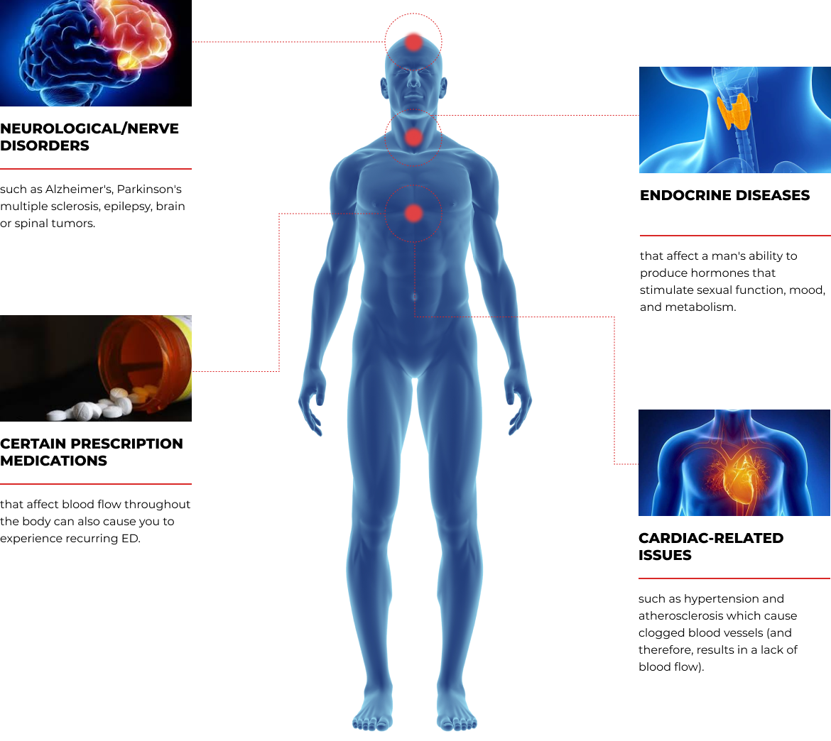  A medical illustration of a male figure with red dots indicating several areas of the body, surrounded by text and smaller images detailing various causes of erectile dysfunction (ED).