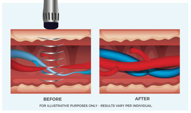 A medical illustration comparing two cross-sections of skin tissue, labeled "BEFORE" and "AFTER," related to a procedure, possibly Extracorporeal Shock Wave Therapy (ESWT) or a similar treatment to improve blood flow.