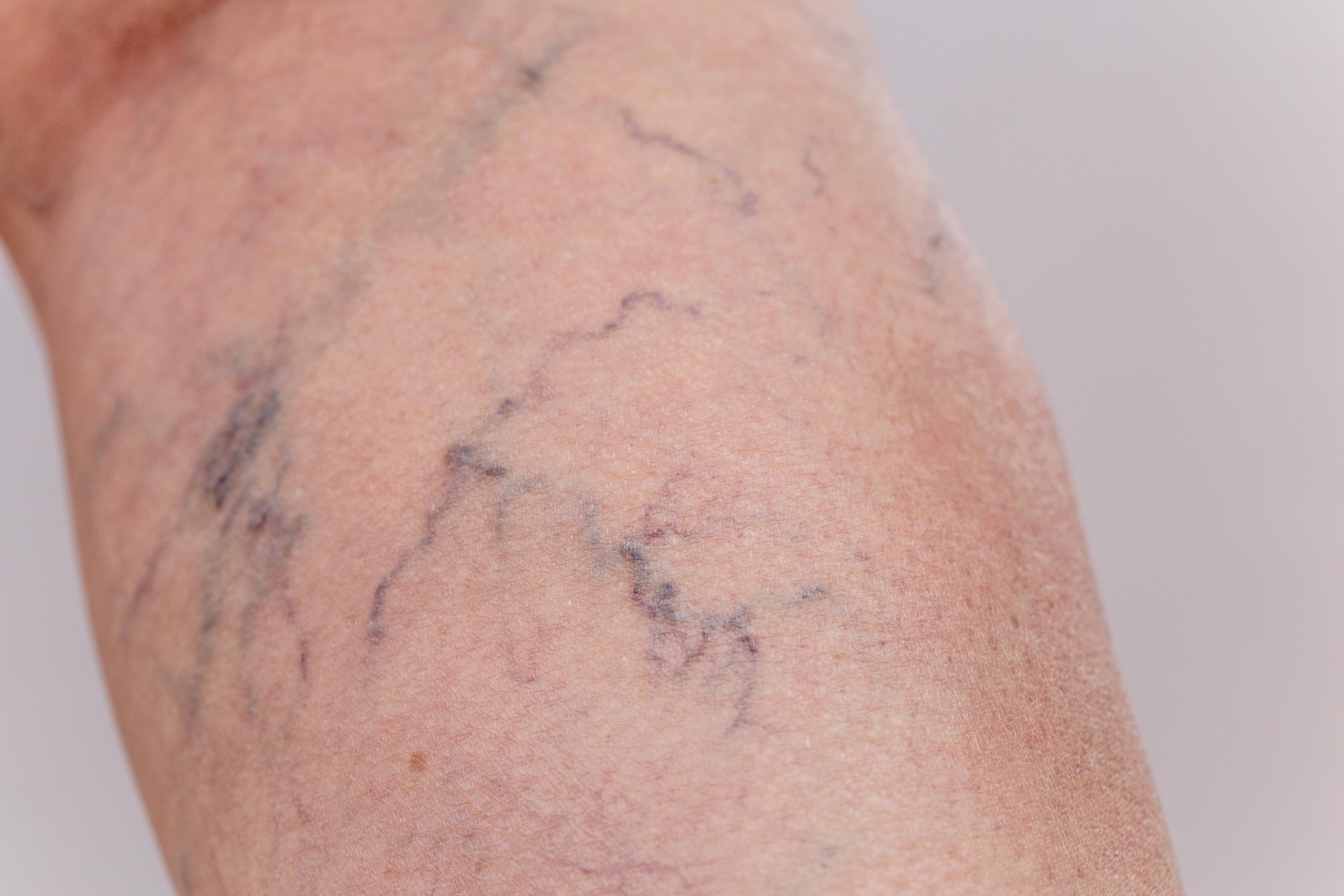 Et nærbilde av en kvinne med sprengte blodkar.