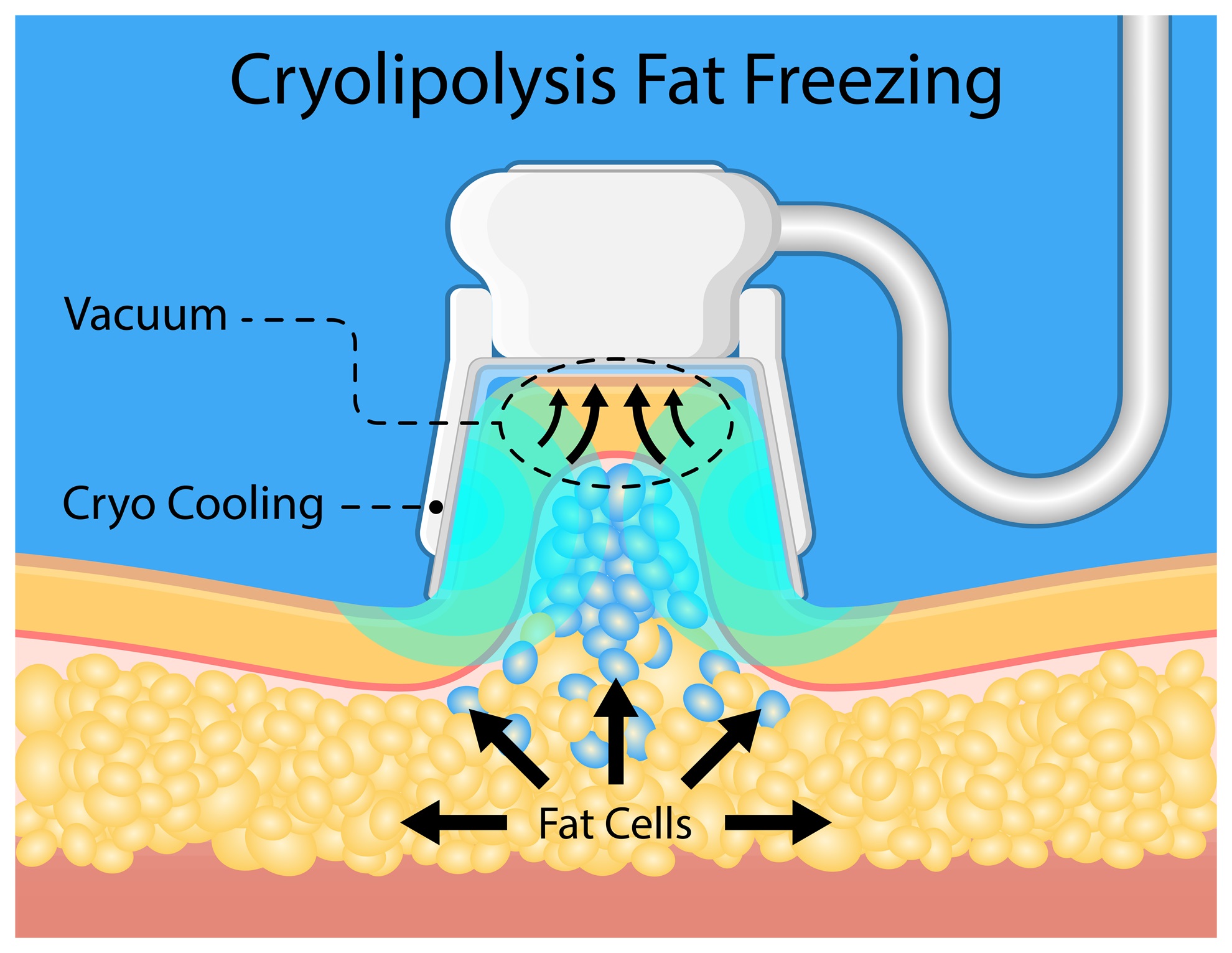 Bilde som viser prosessen med Cryolipolysis (CoolSculpting), der vakuum og kryo-kjøling brukes til å fryse og ødelegge fettceller under huden.
