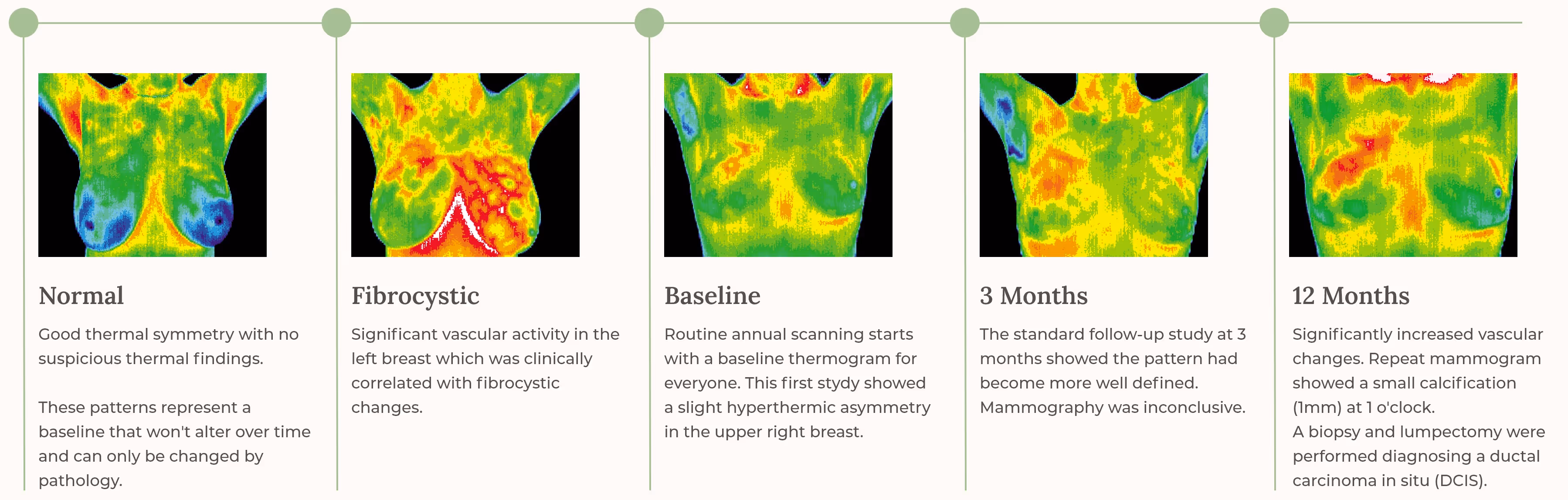 Five thermographic breast images showing progression from normal to fibrocystic, baseline, 3 months, and 12 months with corresponding clinical descriptions.