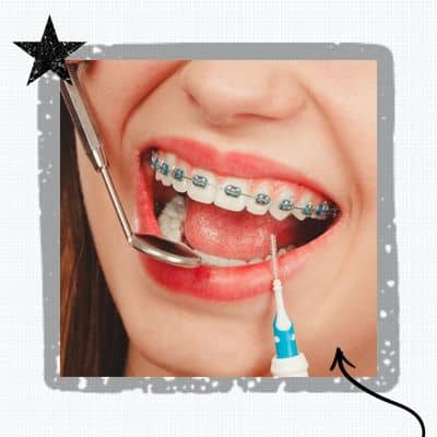 braces