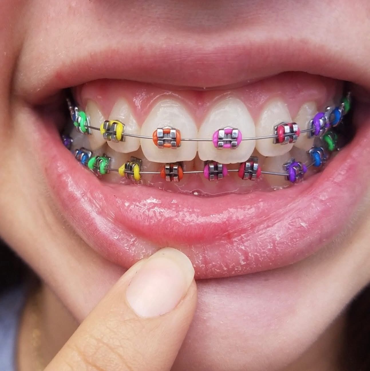 Emergency Orthodontist in Austin