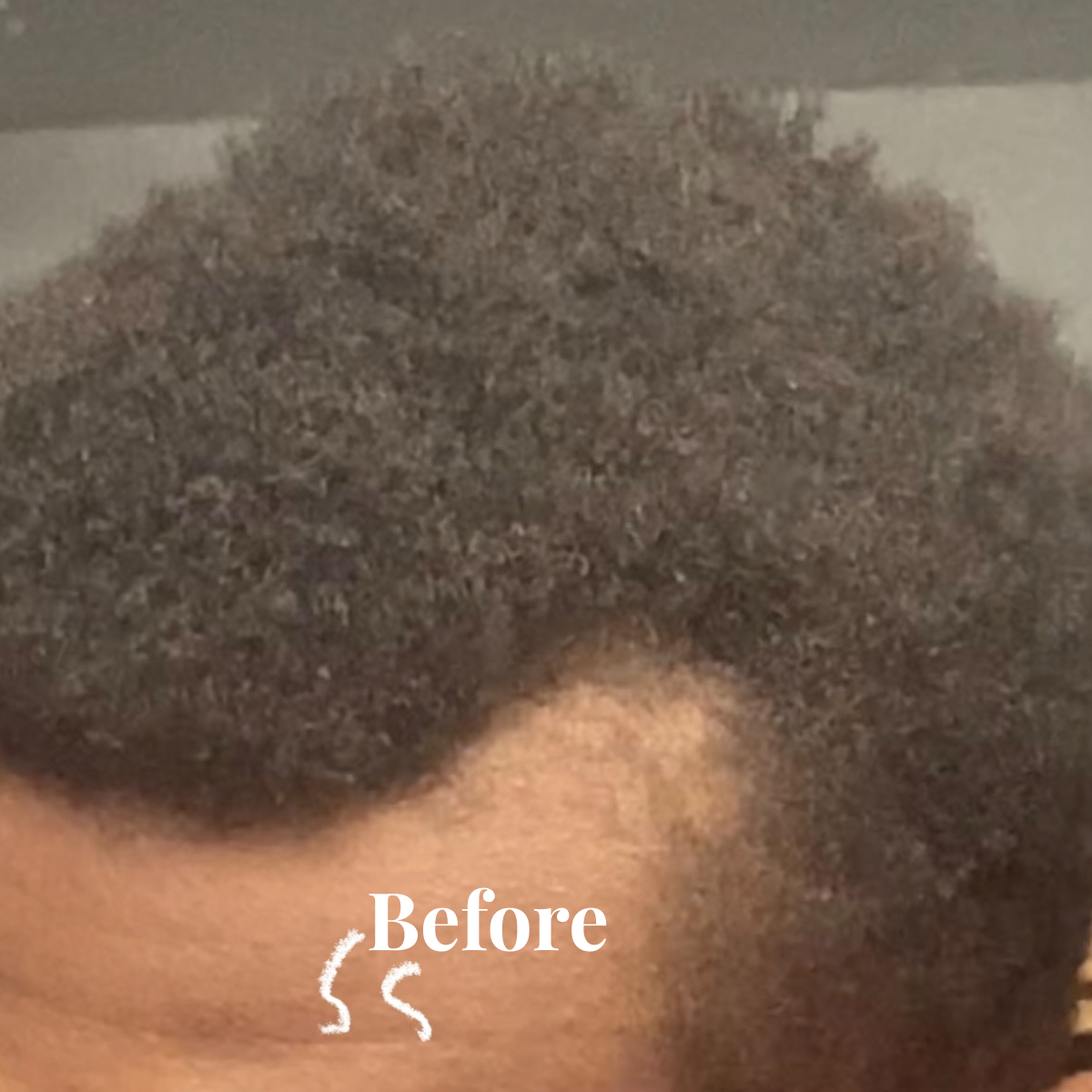 Close-up of a person's hairline with patchy hair loss and 'Before' text overlaid.