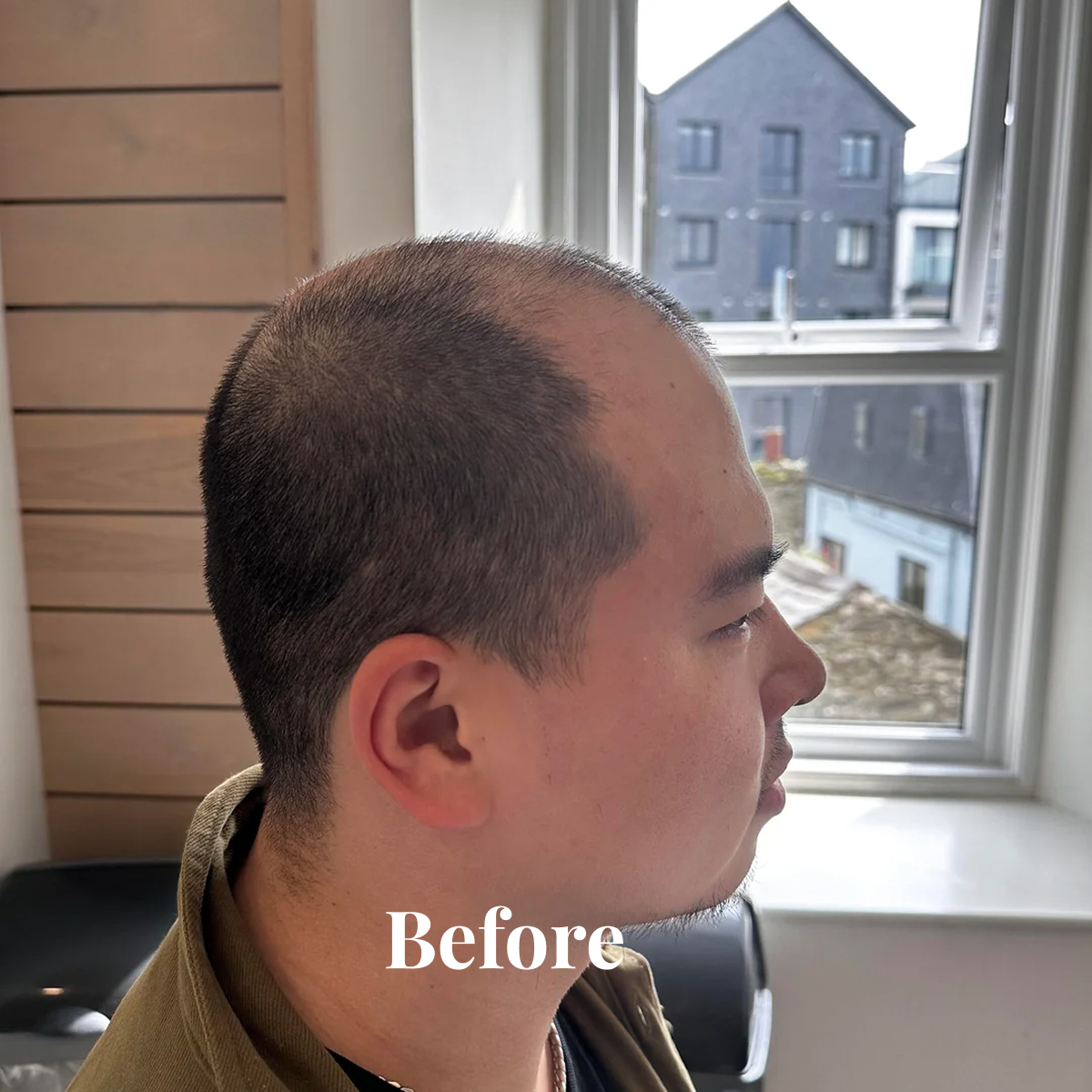 Side profile of a man with thinning hair sitting indoors near a window, with the word 'Before' overlaid.
