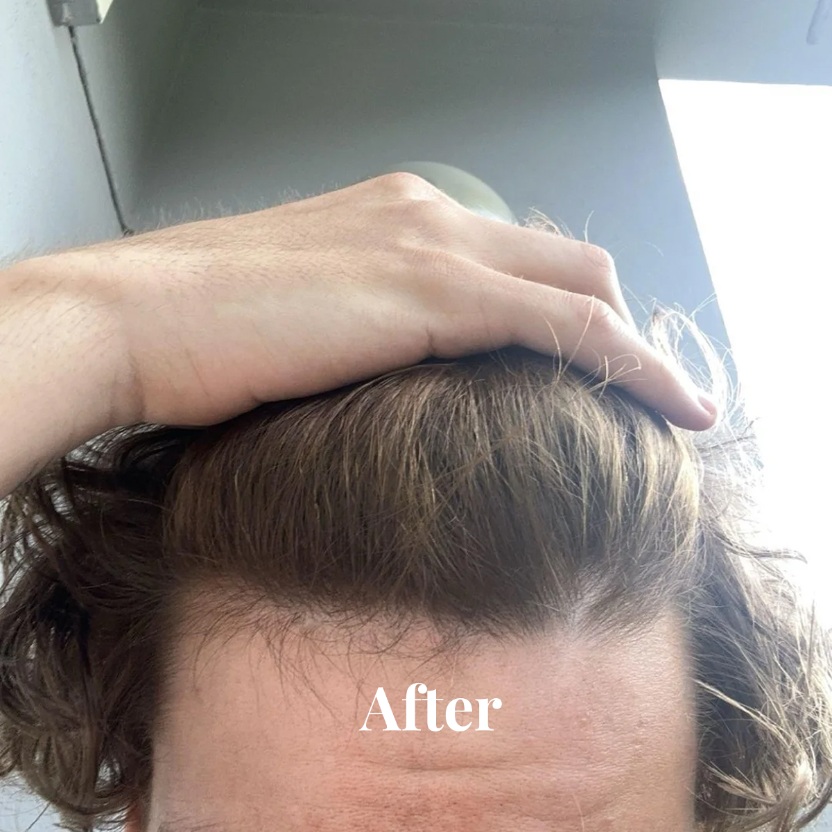 Close-up of a person's forehead and hairline with hair pulled back by hand, labeled 'After'.