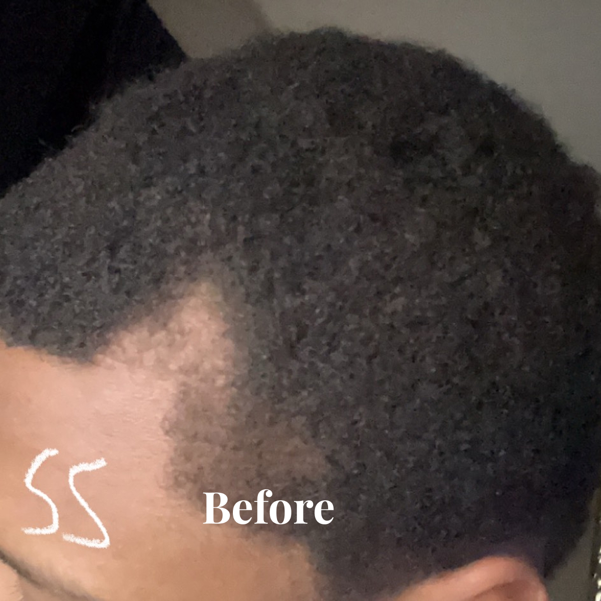 Close-up of a person's head with short, curly hair showing natural hair texture and a defined hairline with the word 'Before' overlaid.