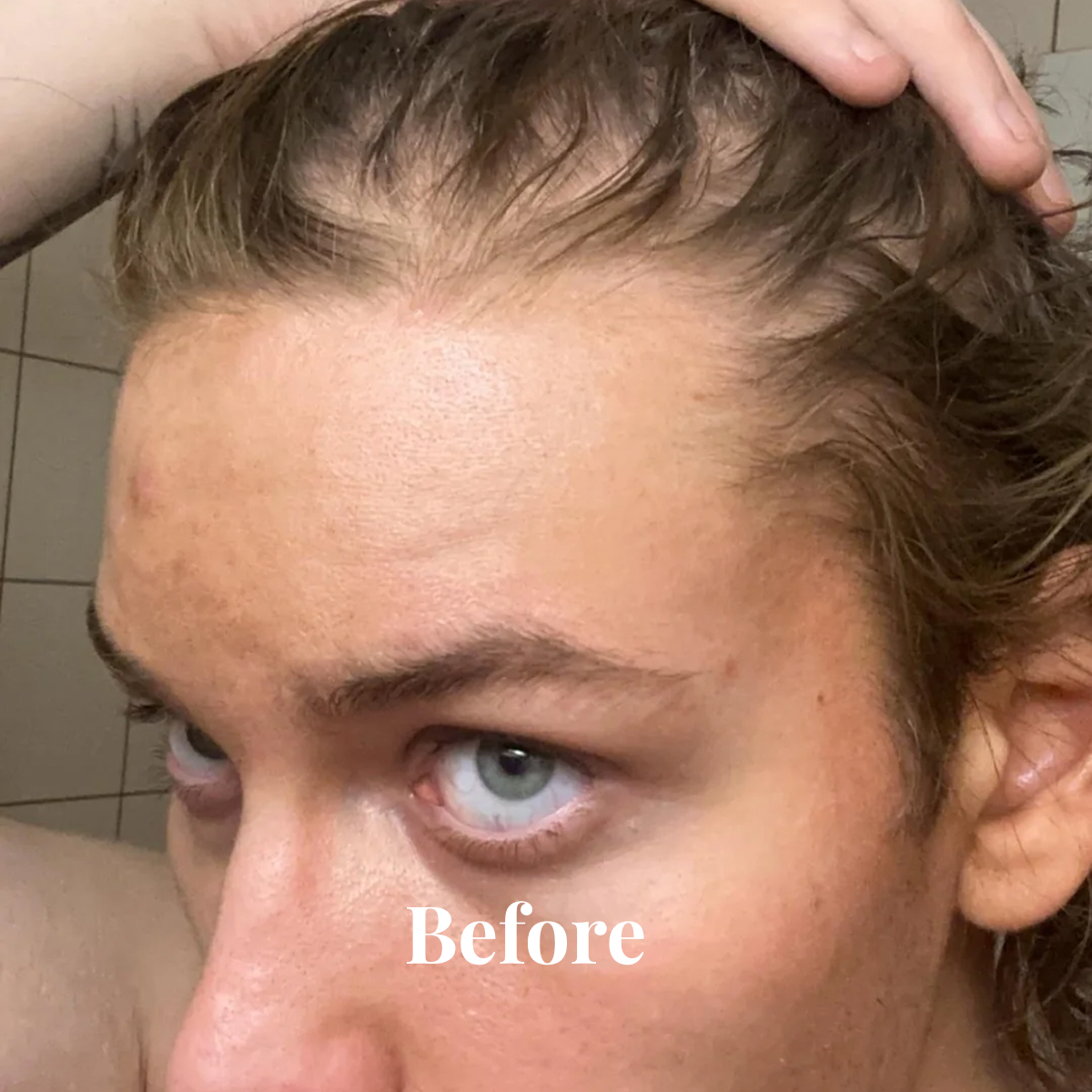 Close-up of a person's forehead and eyes showing light skin with some blemishes, with hand pulling back hair.