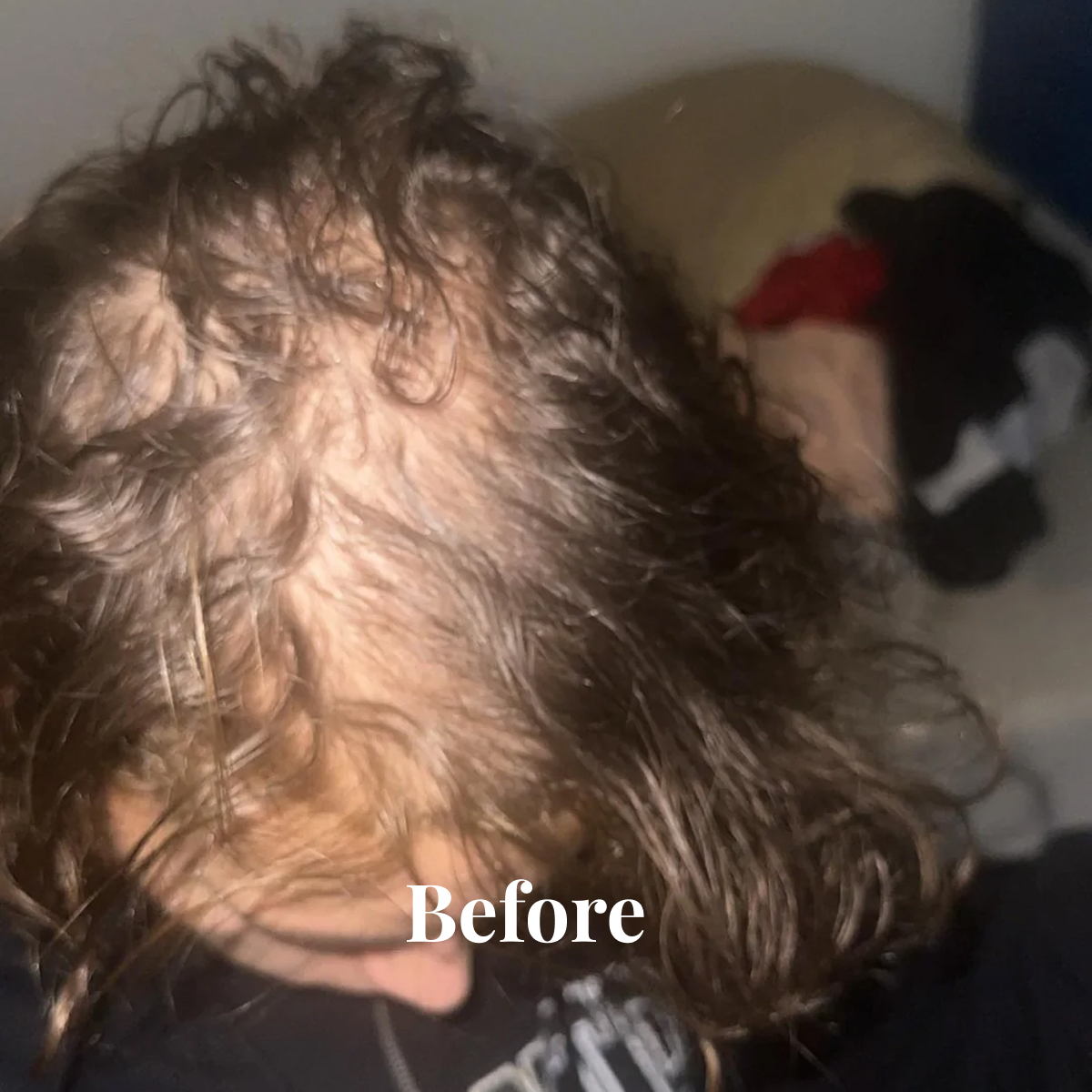 Top view of a person's head with thinning hair and a receding hairline, labeled 'Before'.