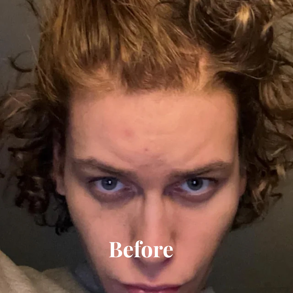 Close-up of a person with curly hair, blue eyes, and visible blemishes on the forehead with the word 'Before' overlaid.