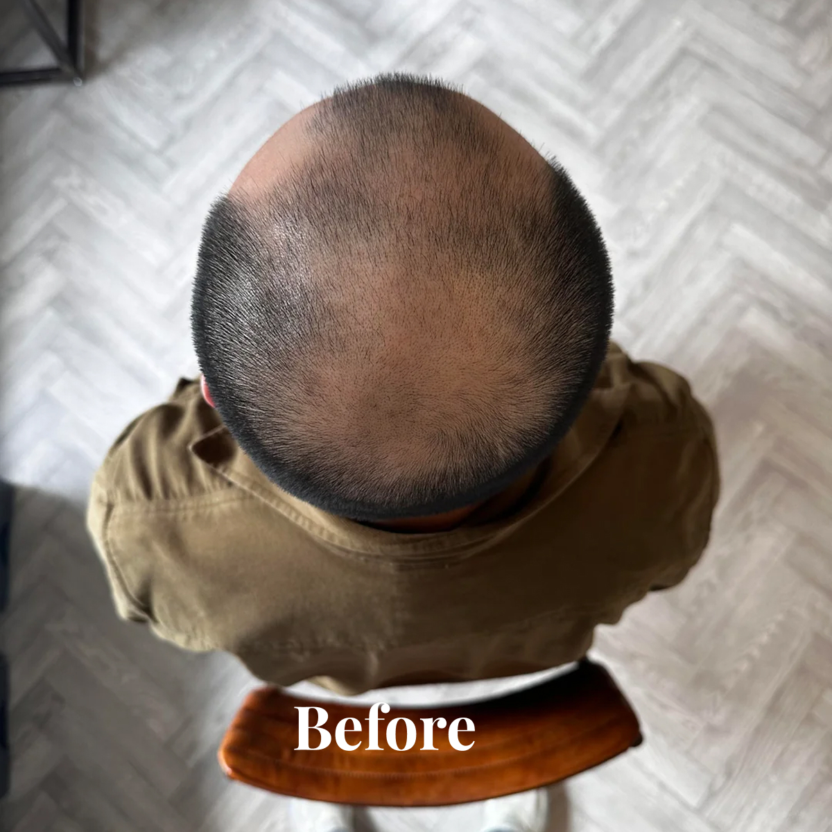 Top view of a person with thinning hair and balding crown sitting on a wooden chair with the word 'Before' at the bottom.