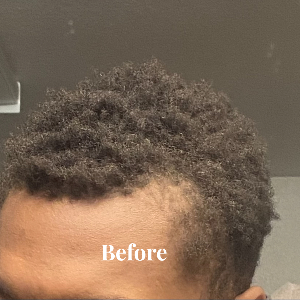 Close-up of a person's curly hair with thinning on the side, labeled 'Before'.