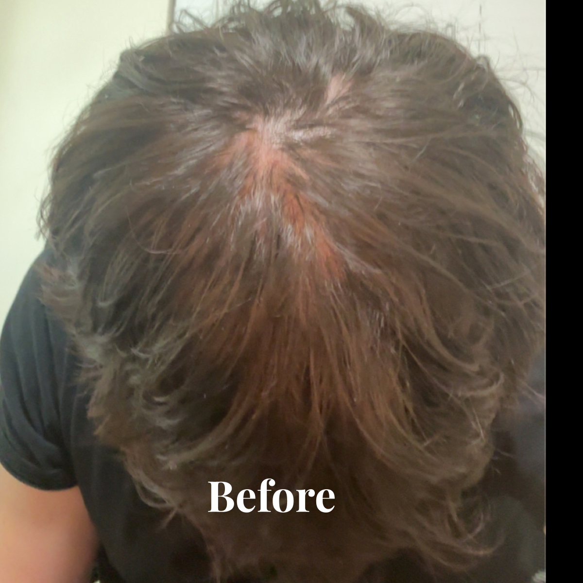 Top view of a person's scalp with thinning brown hair and visible patches of skin labeled 'Before'.