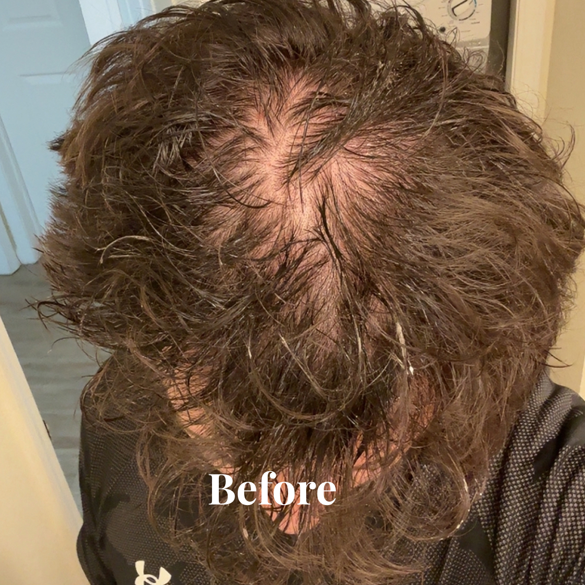 Top view of a person's head with thinning brown hair and visible scalp, labeled 'Before'.