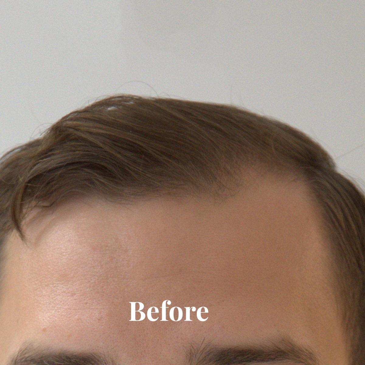 Close-up of a man's forehead and hairline showing thinning hair with the word 'Before' overlaid.