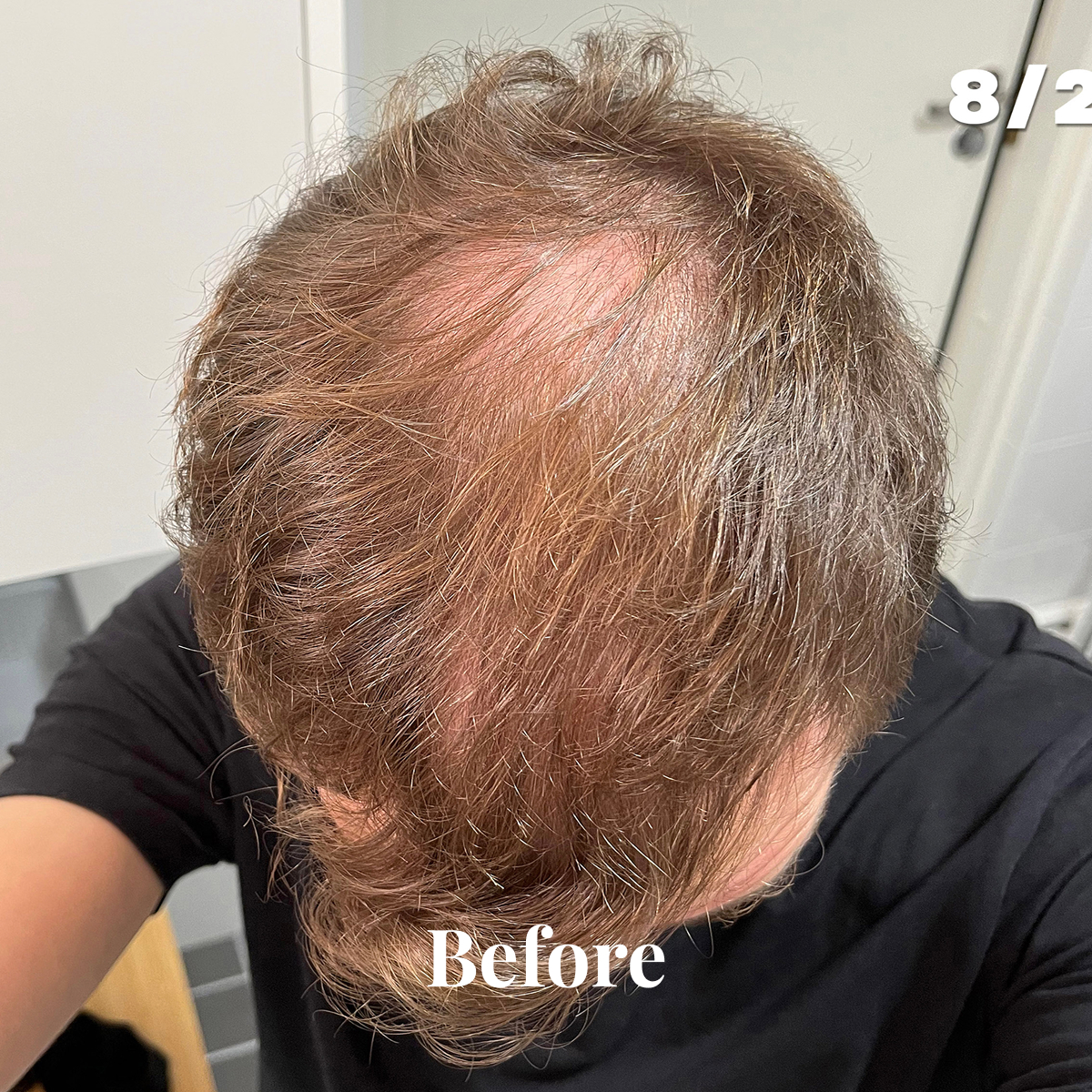 Top view of a person's head with thinning hair and visible scalp labeled 'Before'.