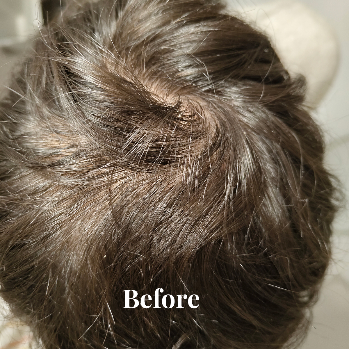 Close-up of the top of a person's head with thin, brown hair showing scalp and the word 'Before'.
