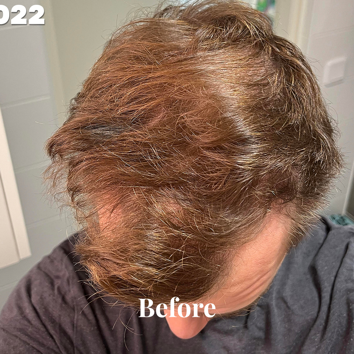 Top view of a person with thinning brown hair and visible scalp, wearing a dark shirt.