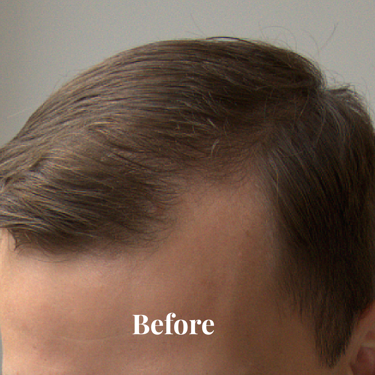 Close-up of a man's head showing a receding hairline with the word 'Before' overlaid.
