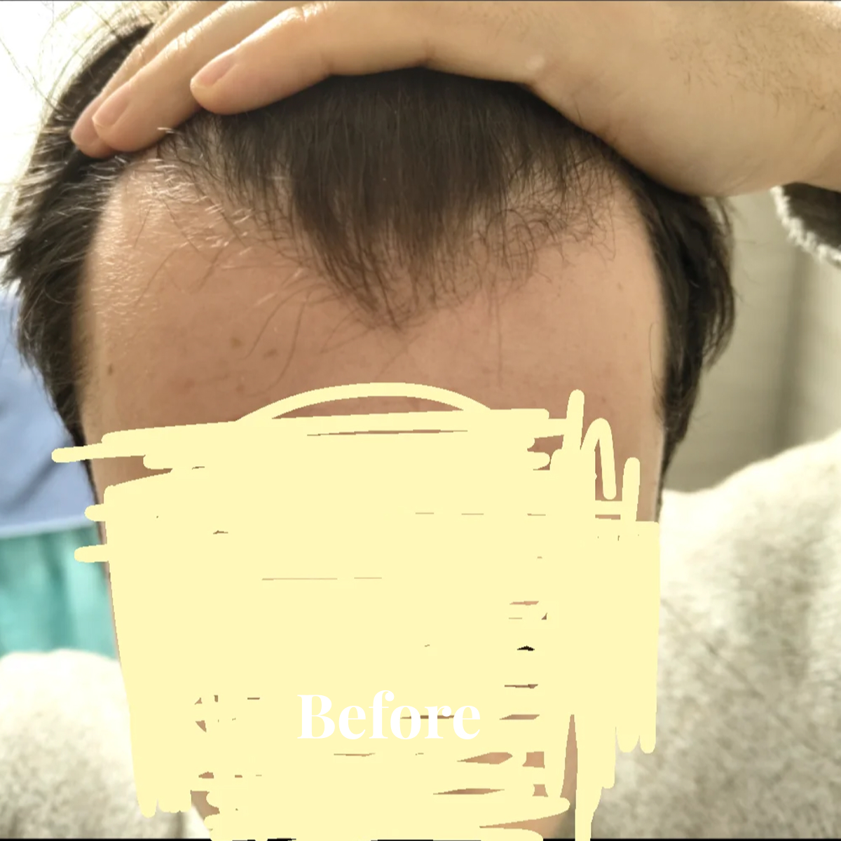 Close-up of a person’s forehead with thinning hair, hand placed on top of the head.