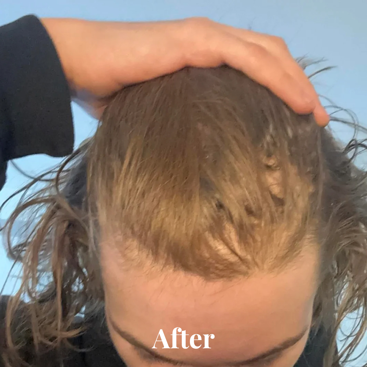 Close-up of a person's scalp and hair with a hand gently resting on top, showing hair growth improvement with the label 'After'.