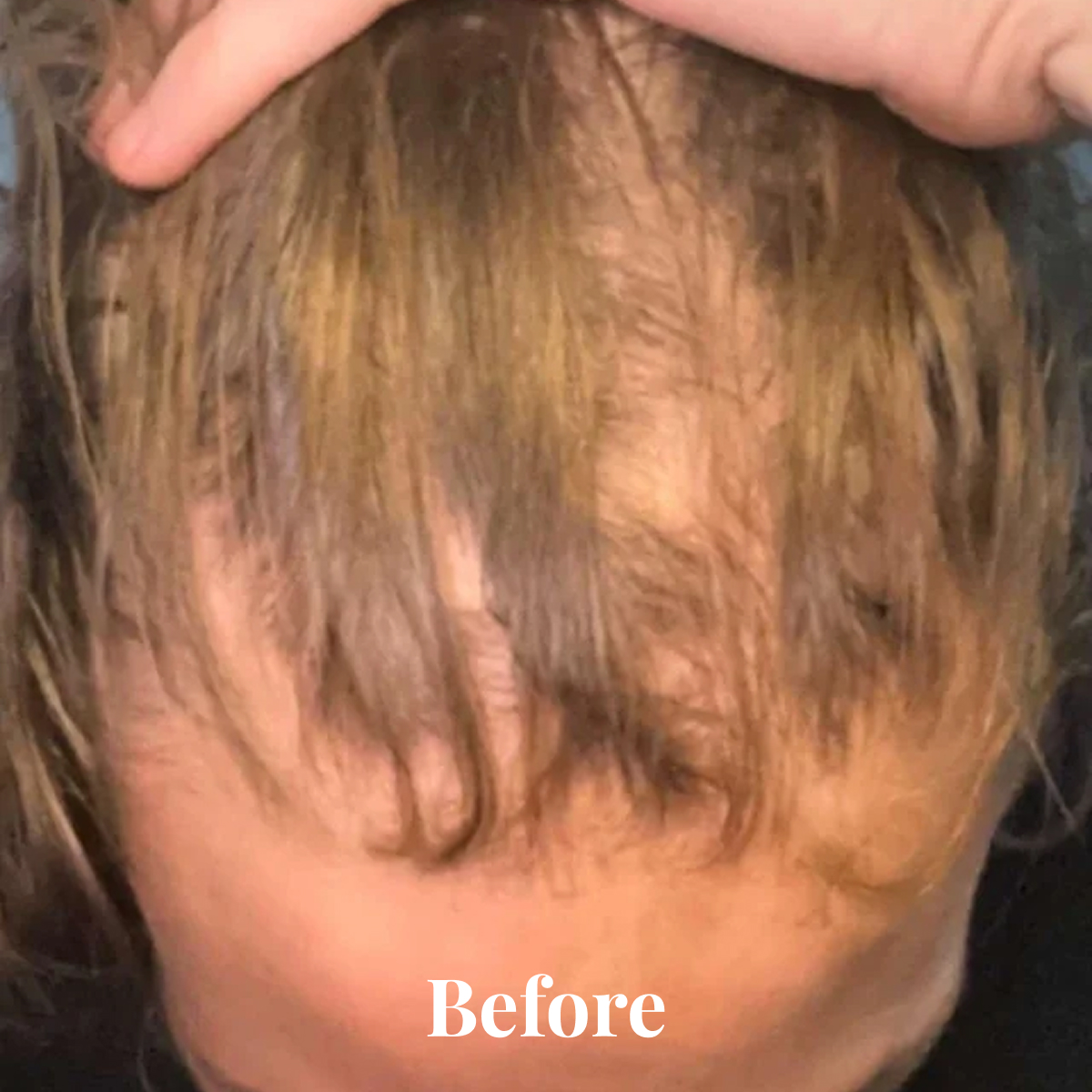Close-up of a person's scalp with thinning hair and a hand lifting some strands, text reads 'Before'.