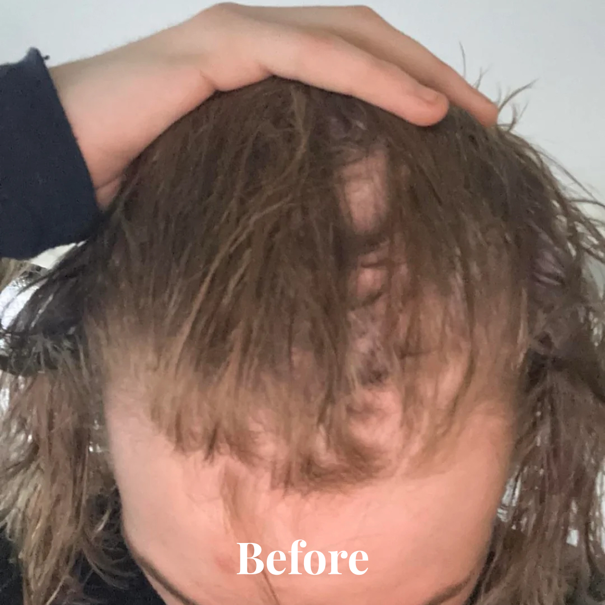 Top view of a person with thinning brown hair and noticeable scalp showing, holding hair back with hand, with 'Before' text at bottom.
