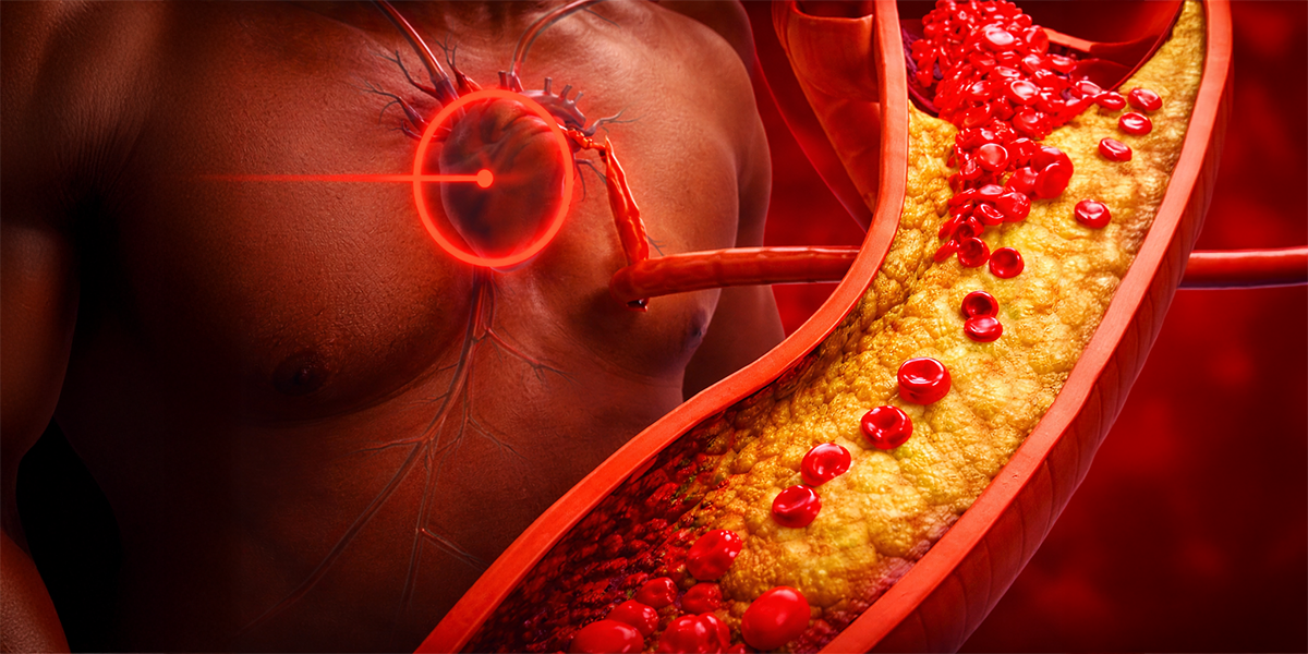 Medical illustration of cholesterol plaque buildup in an artery near the heart representing high cholesterol and cardiovascular disease risk