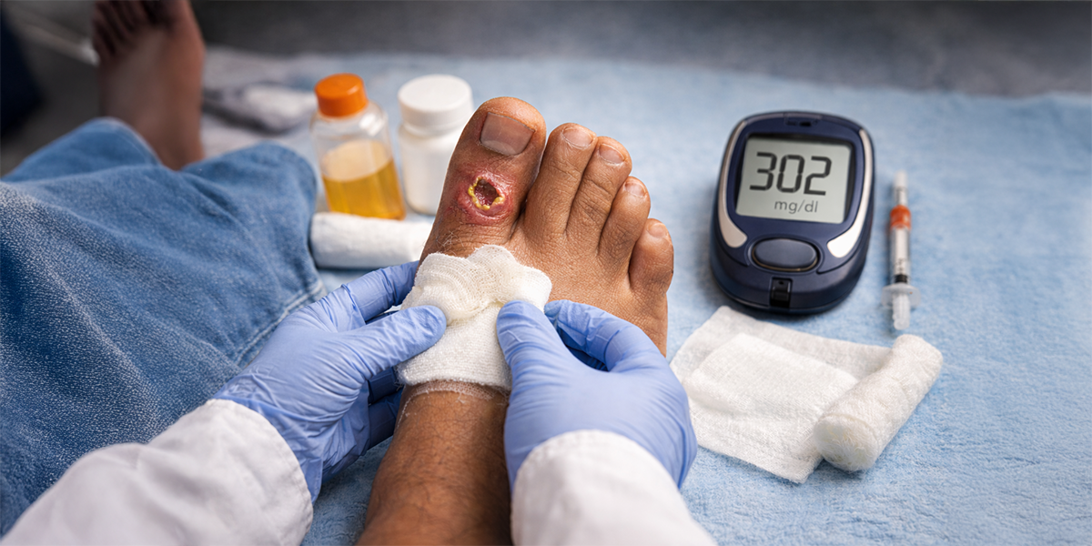 Healthcare professional dressing diabetic foot wound with glucometer showing high blood sugar level