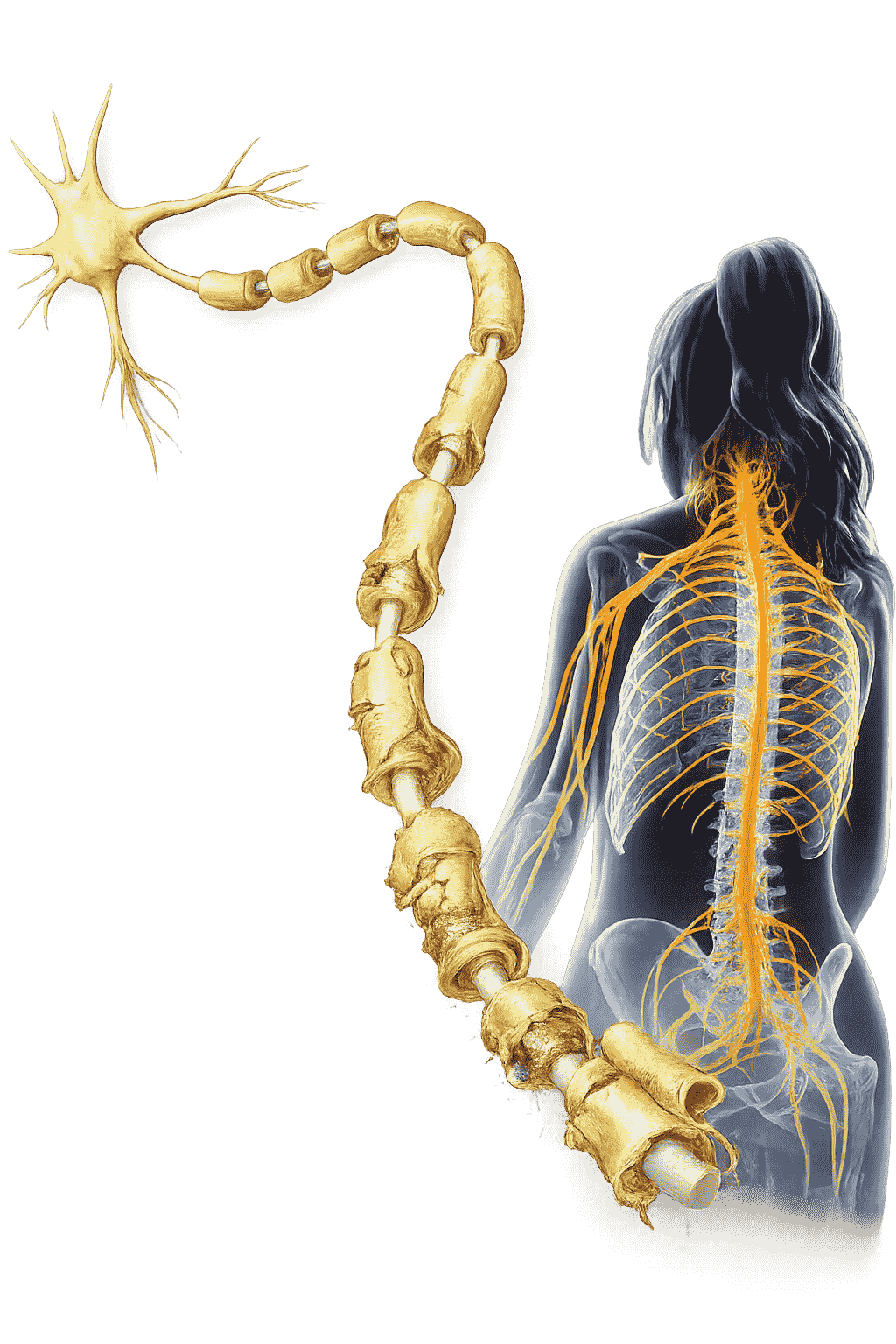 Medical illustration of the nervous system and spinal cord highlighting nerve damage associated with multiple sclerosis.