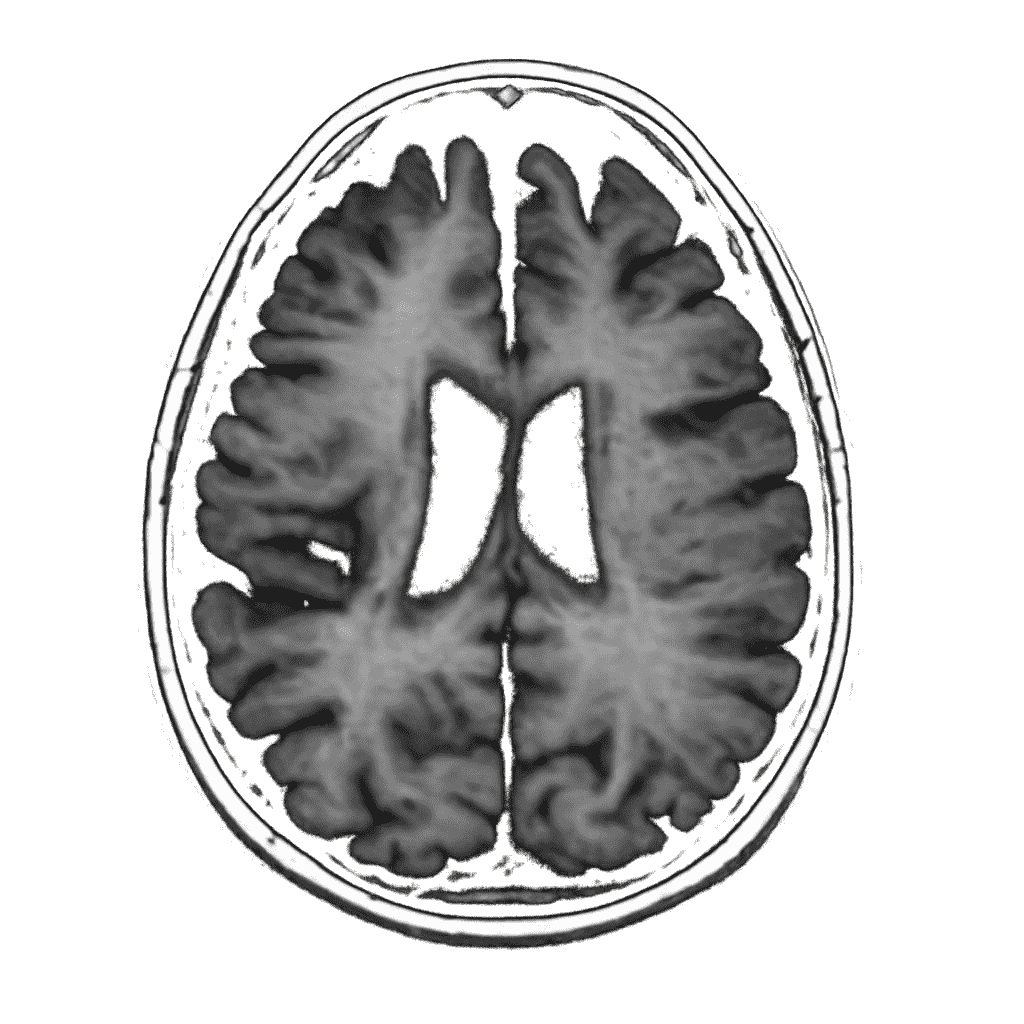 Medical brain scan illustration showing reduced brain tissue volume associated with brain atrophy and neurodegeneration.