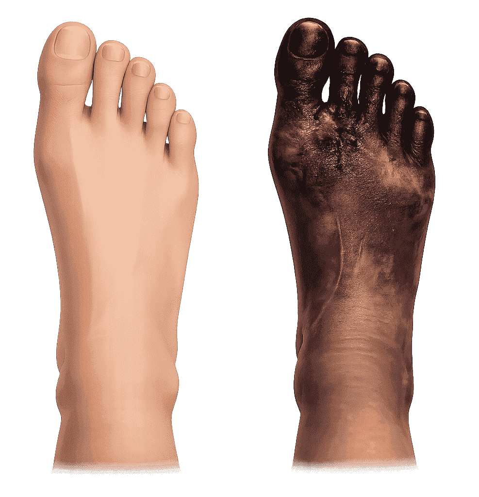 Comparison illustration of a healthy foot and a gangrene-affected foot showing tissue damage, representing care focused on circulation and tissue health.