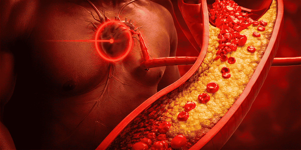Medical illustration of cholesterol plaque buildup in an artery near the heart representing high cholesterol and cardiovascular disease risk