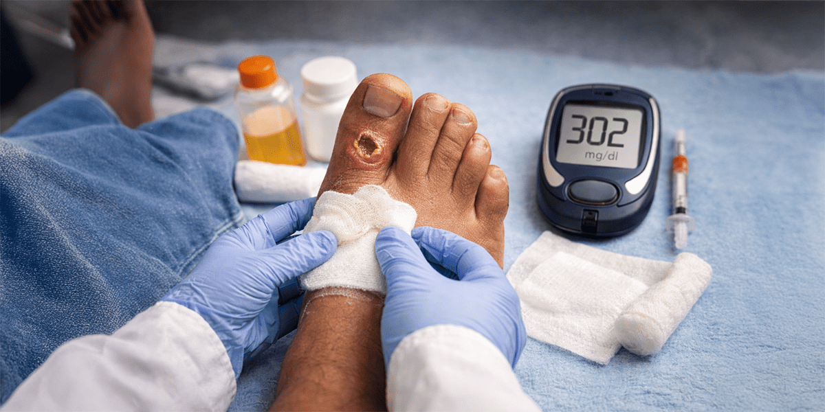 Healthcare professional dressing diabetic foot wound with glucometer showing high blood sugar level