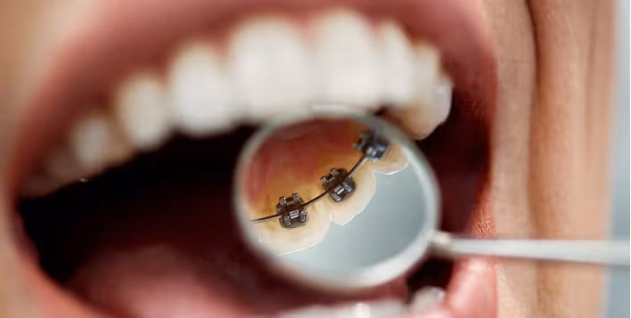 Lingual braces