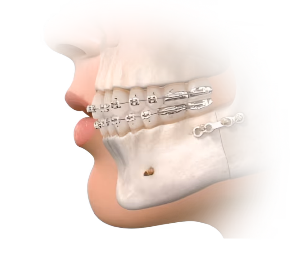 Seitliche Darstellung eines Kiefers mit festsitzender Zahnspange und chirurgischen Korrekturelementen – Beispiel für kieferorthopädische und kieferchirurgische Behandlung.