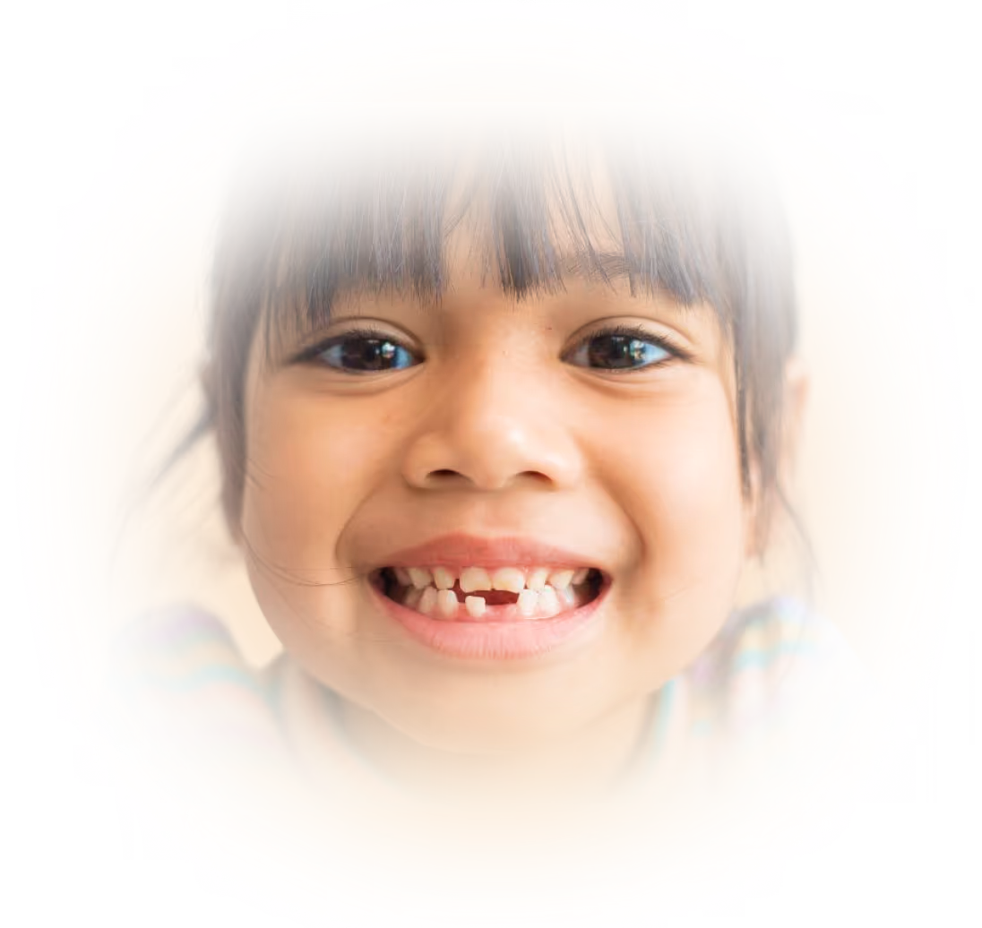 Lächelndes Kind mit fehlenden Schneidezähnen – natürliche Zahnwechselphase bei Kindern.