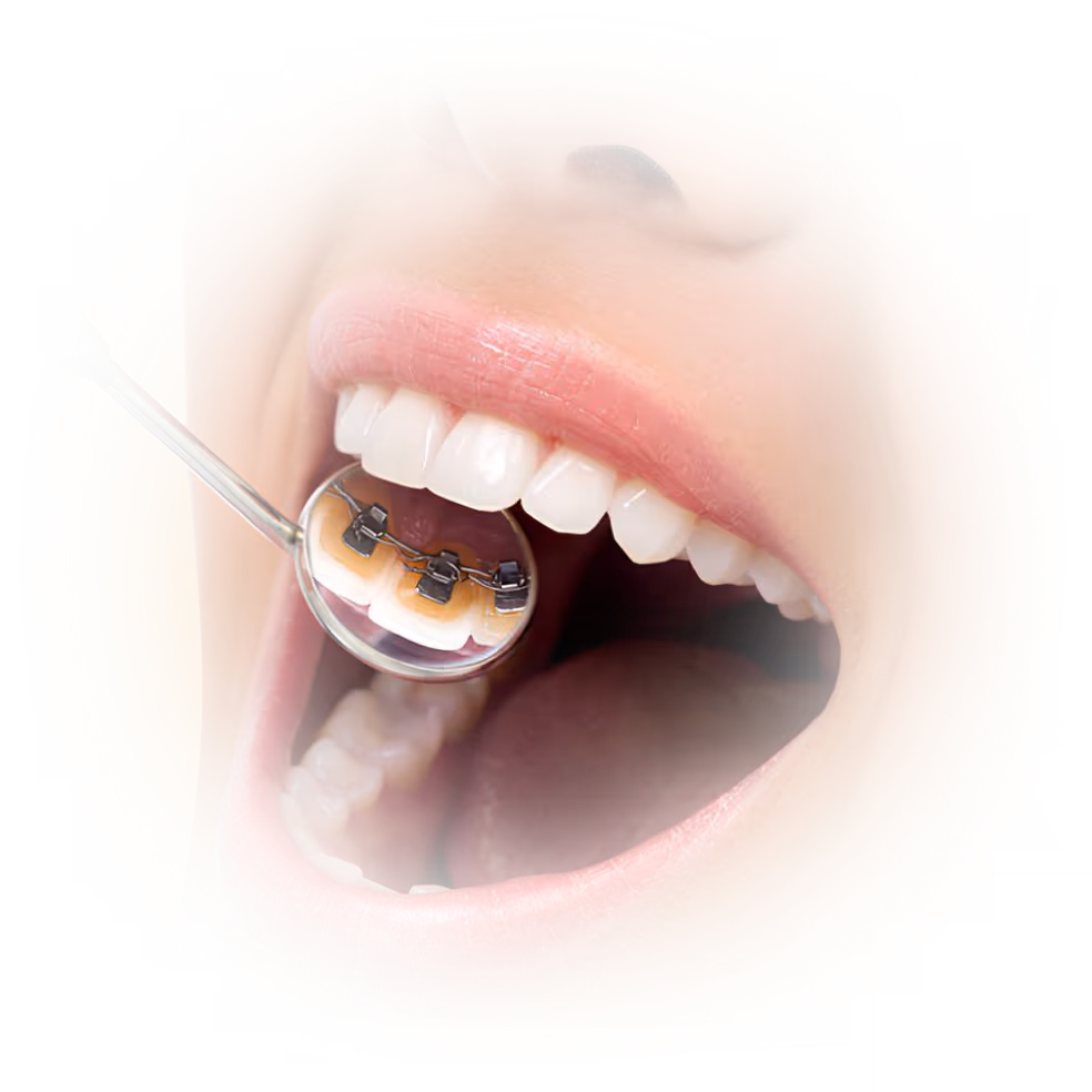 Nahaufnahme eines geöffneten Mundes mit innenliegenden Zahnspangen (Lingualbrackets), untersucht mit einem Dentalspiegel – moderne Kieferorthopädie.