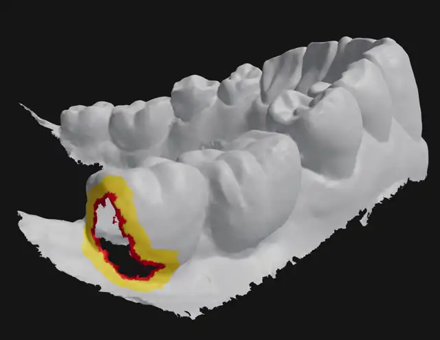 3D intraoral scan with an unrecorded area highlighted by the AI Employee