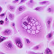 Microscopic view of purple-stained cancer cells with irregular nuclei and shapes.