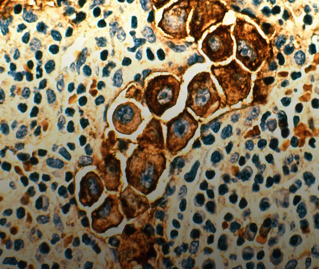 Microscopic view of stained cells showing clusters of dark brown and blue nuclei against a light background.