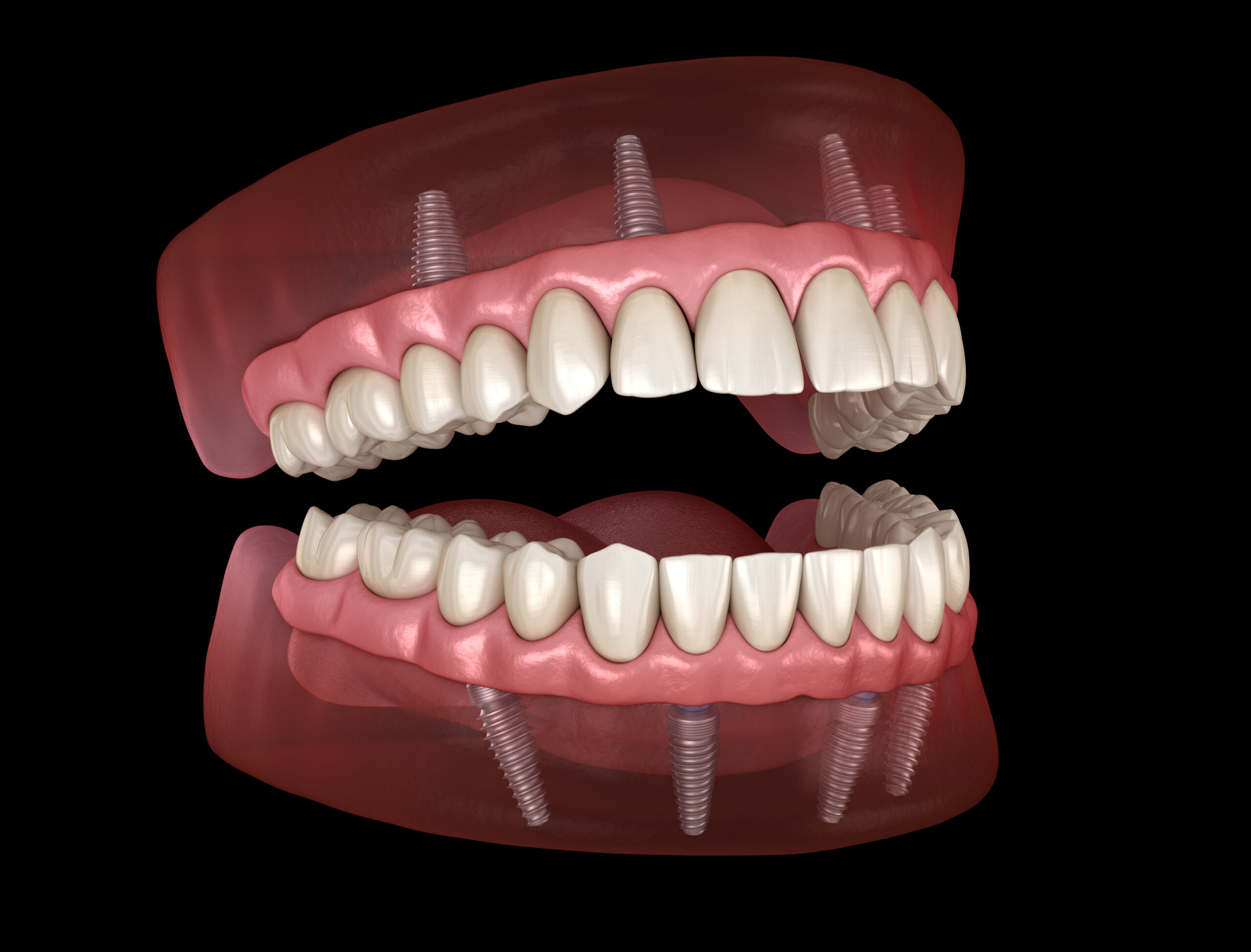 3D illustration of upper and lower dental implants anchored in gums with attached artificial teeth.